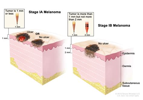 stage 1b melanoma treatment