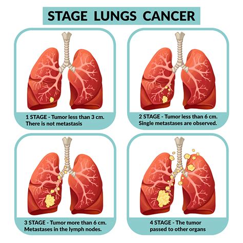 stage 3 lung cancer treatment