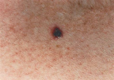 stage 3 nodular melanoma