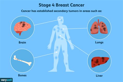 stage 4 breast cancer