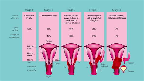 stage 4 endometrial cancer survivor stories