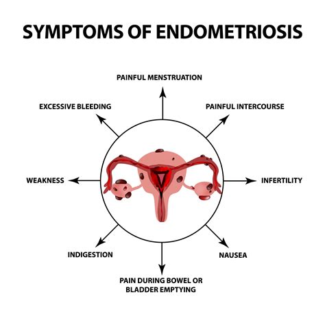 stage 4 endometriosis treatment options