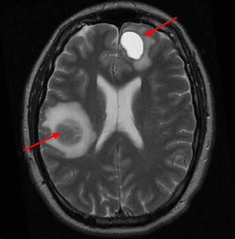 stage 4 melanoma brain cancer life expectancy