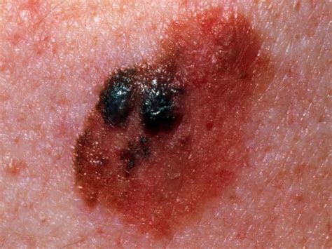 stage 4 melanoma pictures