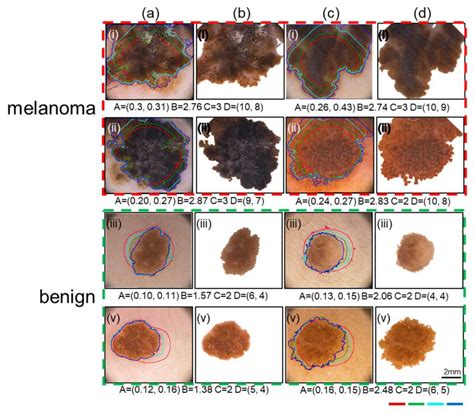 stage 4 melanoma skin cancer