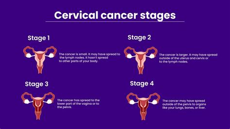 stage iv cervical cancer icd 10