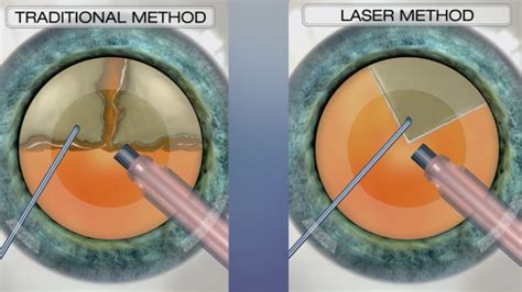 standard cataract surgery vs laser surgery