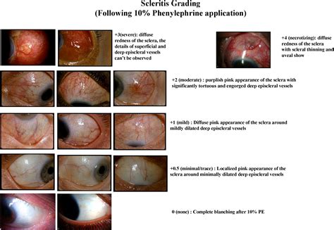 Standardized Grading System For Scleritis