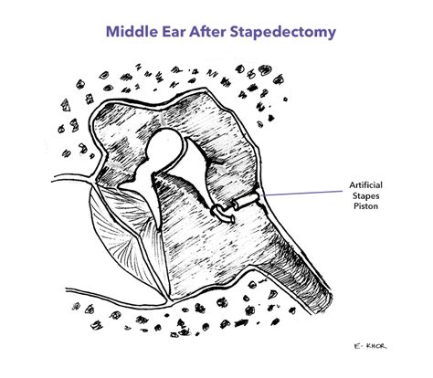 Stapedectomy Success: Your Guide to Improved Hearing Health