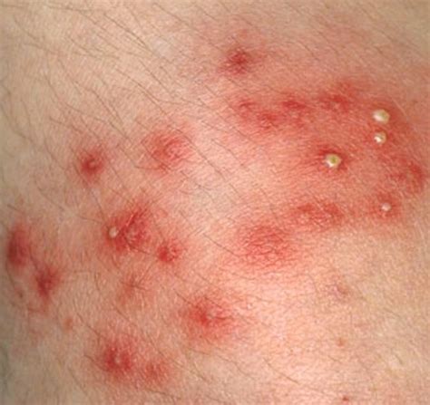 Staph Infection Armpit: Causes, Symptoms, and Effective Treatments