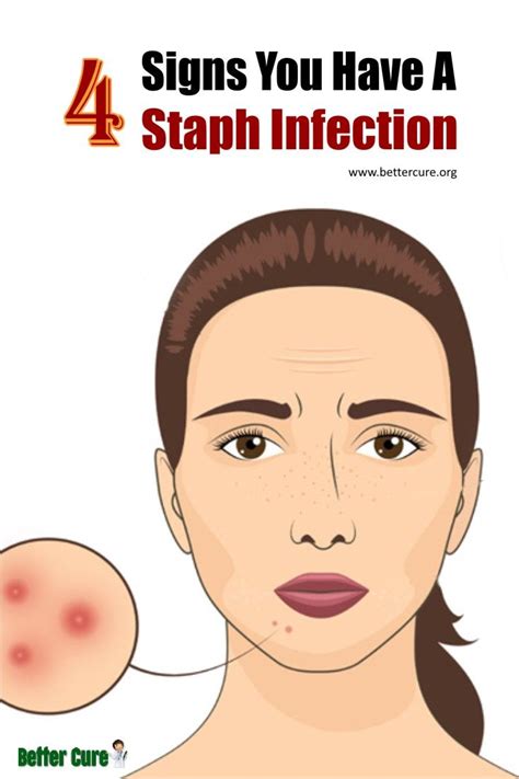 Staph Infection From Razor