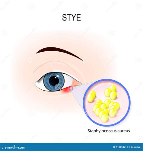 Staphylococcus Bacteria Eye