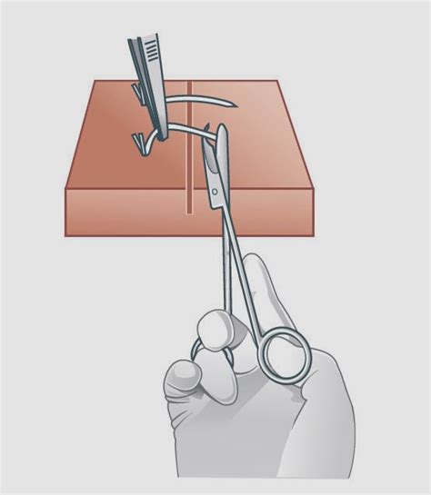 Staple Removal Nursing