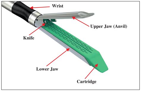 Staples In Laparoscopic Surgery