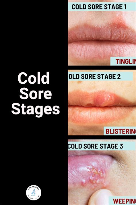 Catch the Warning Signs: Identifying the Start of a Cold Sore Before It Spreads