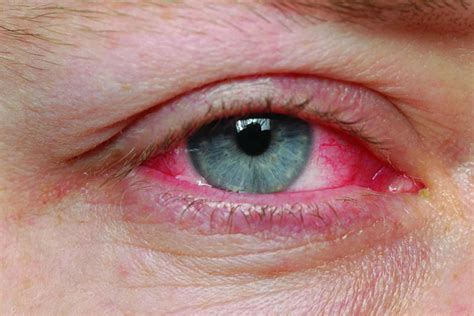 Understanding the Start of Pink Eye: Early Signs and Symptoms to Watch For