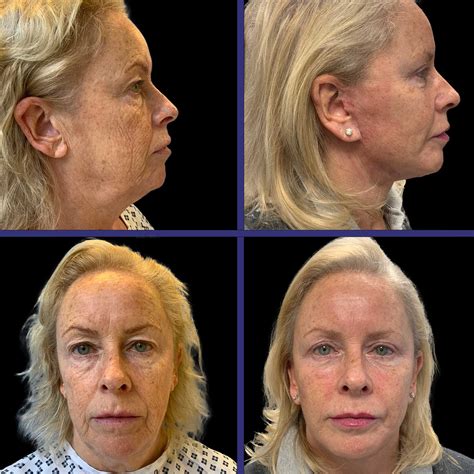 stem cell facelift before and after