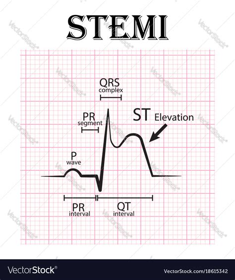 Understanding STEMI in EKG: A Comprehensive Diagnostic Guide