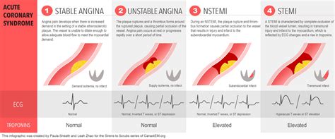 stemi type 1 and 2