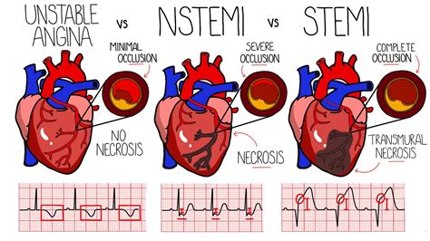 stemi vs acute mi