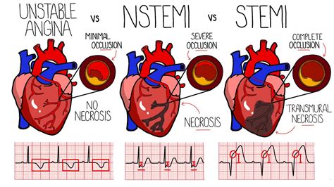 stemi vs non stemi heart attack