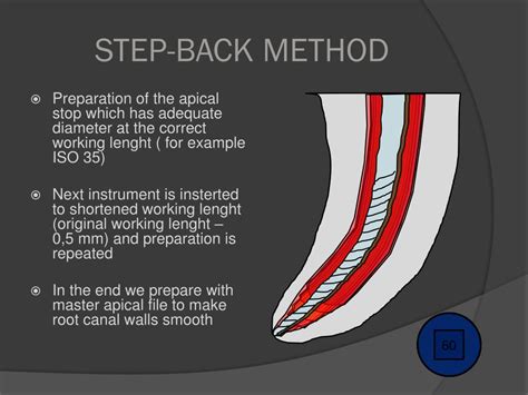 Step Back Technique In Endodontics Slideshare