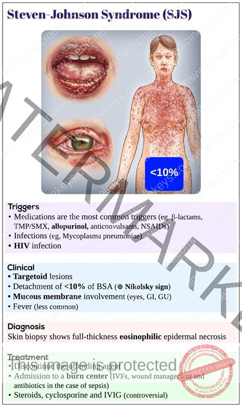 Understanding Stephen Johnson Syndrome: Causes and Treatment Options