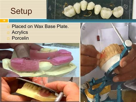 Steps For Making Removable Partial Denture