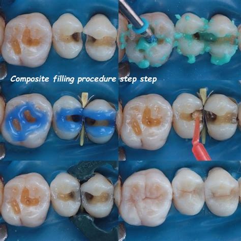 Steps Of A Composite Procedure In Order