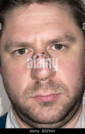 Steri Strip Dog Bite