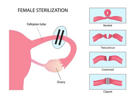 Sterilization Hysterectomy