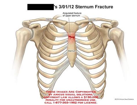 sternal manubrium fracture icd 10