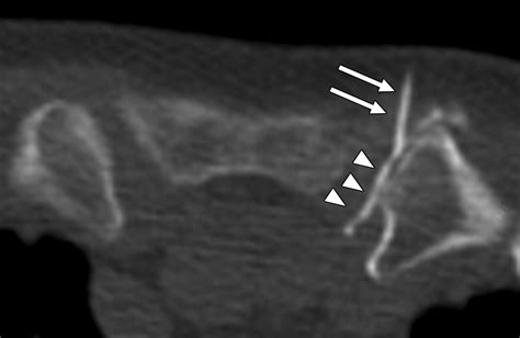 sternoclavicular joint steroid injection cpt code
