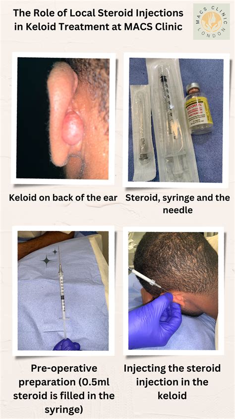 Steroid Injection Ear Keloid