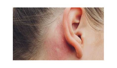 Stiche im Ohr und Kopf, eine typische folgeinfektion bei verschleppung