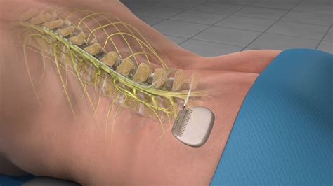Say Goodbye to Back Pain: Discover the Power of a Stimulator for Back Pain Relief