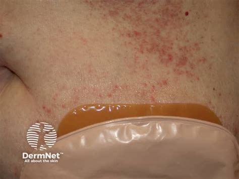 Stoma Skin Problems