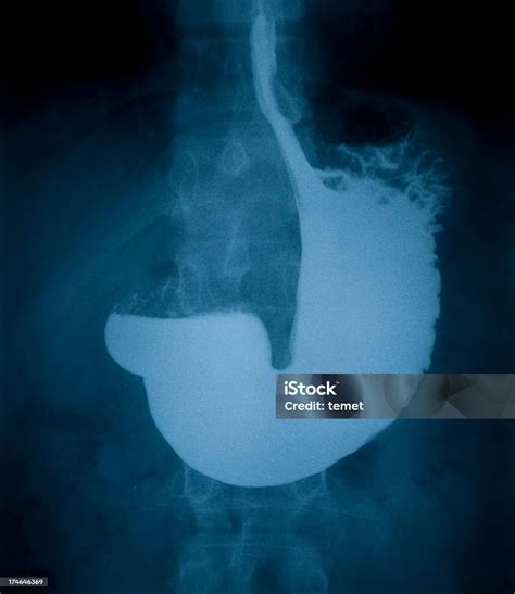 What Does a Stomach X-Ray Reveal About Your Digestive Health?