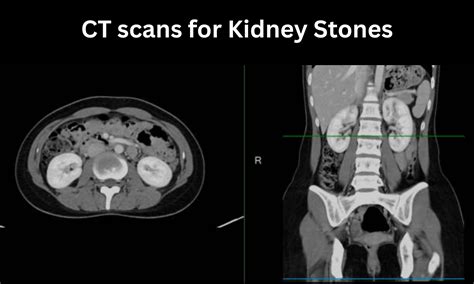 stone ct
