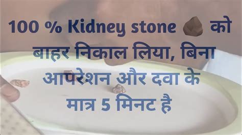 Stone Remove Without Operation