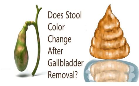 Stool Changes With Gallbladder Problems