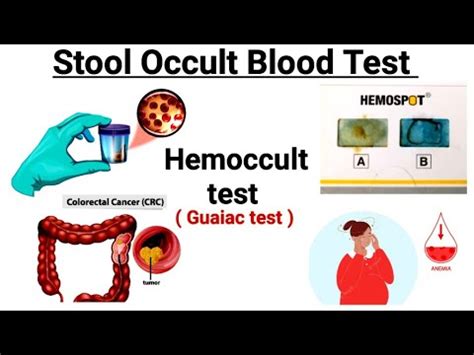Stool Guaiac Hemoccult Test for Early Colon Cancer Detection