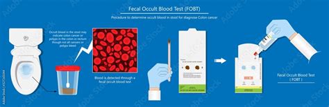 Understanding the Stool Guaiac Test for Hidden Blood
