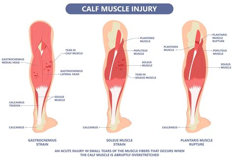 Understanding and Managing a Strained Calf Muscle Effectively
