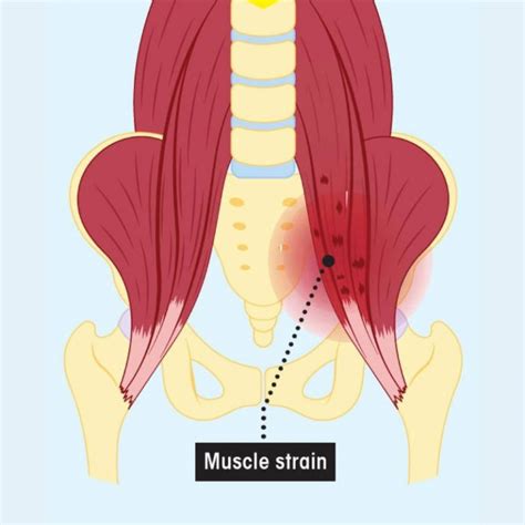 Heal Your Strained Hip Flexor with Proven Recovery Techniques