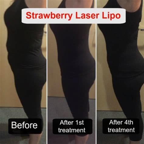 strawberry laser lipo treatment reviews