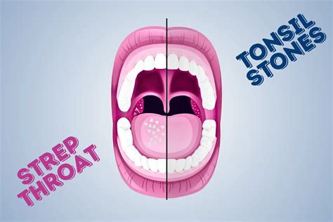 strep throat vs tonsil stones