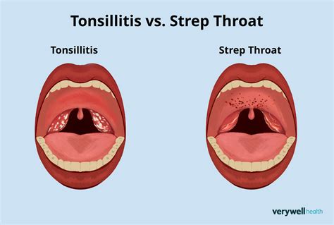 Strep Throat vs Tonsillitis: Unraveling the Mystery of Throat Infections