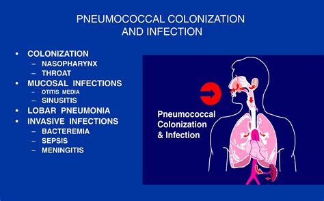 streptococcus pneumoniae clinical findings