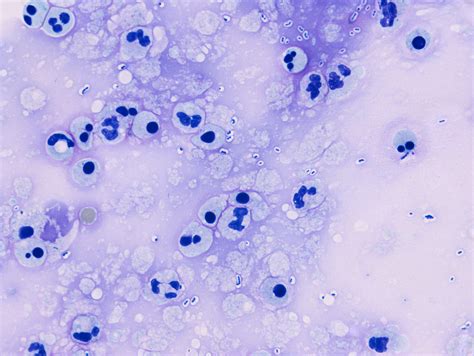 streptococcus pneumoniae meningitis